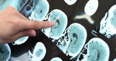 Behandlung von Alzheimer und Demenz: Einfluss der Chronobiologie